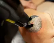 Tattoo Removal Gives Australians Second Chance From Gang Signs to Nazi Symbols