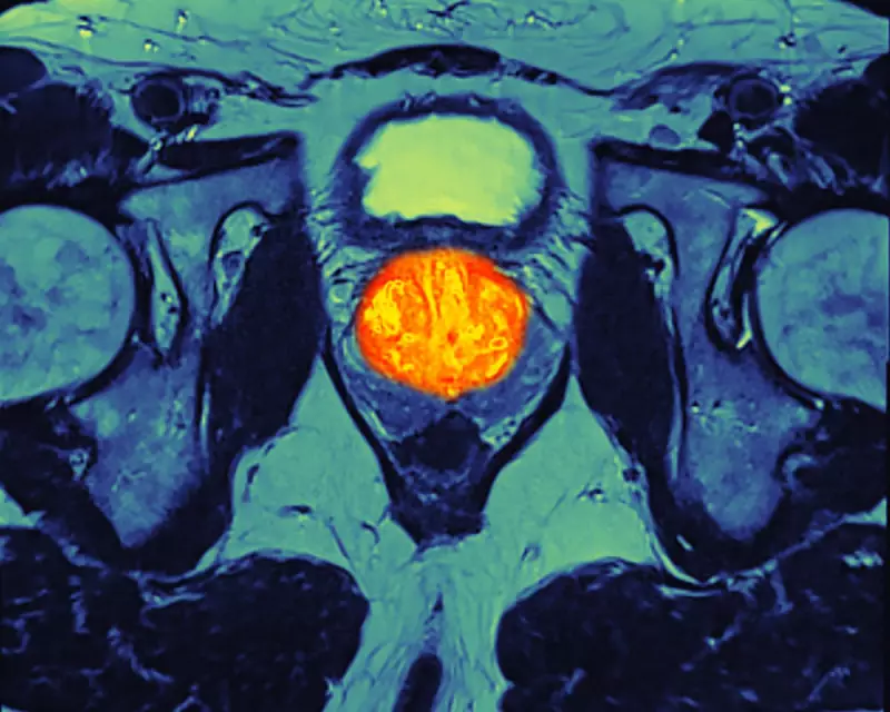 NHS England Expands Prostate Cancer Drug, Set to Save Thousands of Lives