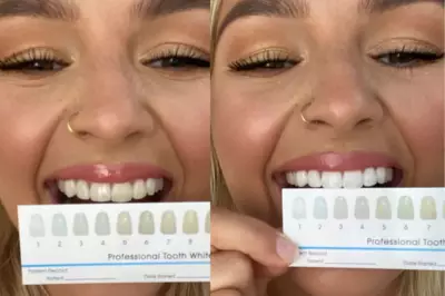 I Tried SmilePro Teeth Whitening Kit: My Incredible One-Week Results