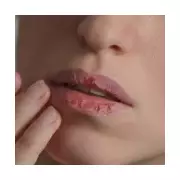 Chapped Lips Mystery Solved: Why Balms Fail & When It's a Fungus