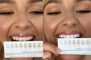 Smile Pro Teeth Whitening Kit Review: Dramatic Results in Just 7 Days
