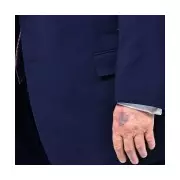 Trump's Bruised Hand Sparks Health Questions at Davos Forum