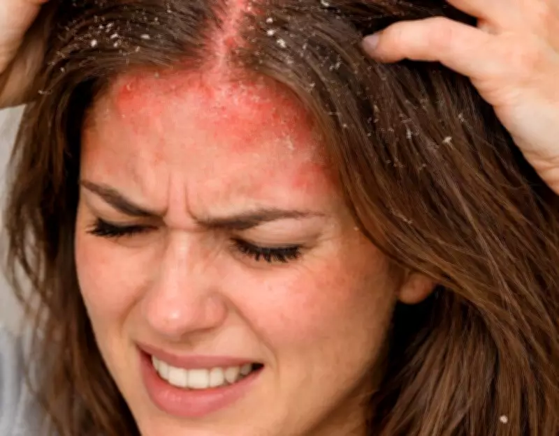 London's Hard Water Crisis: Scalp Health Under Threat