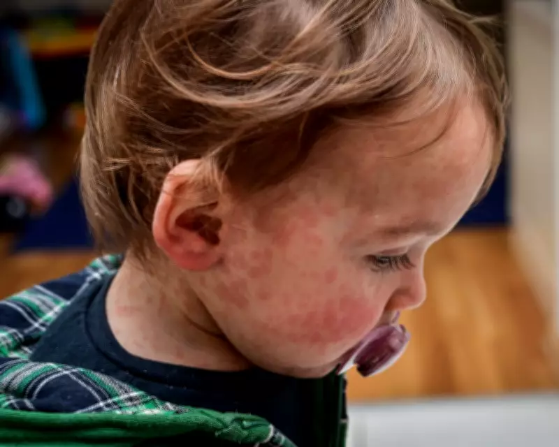 Measles Outbreak in London: How to Protect Your Child from the Virus
