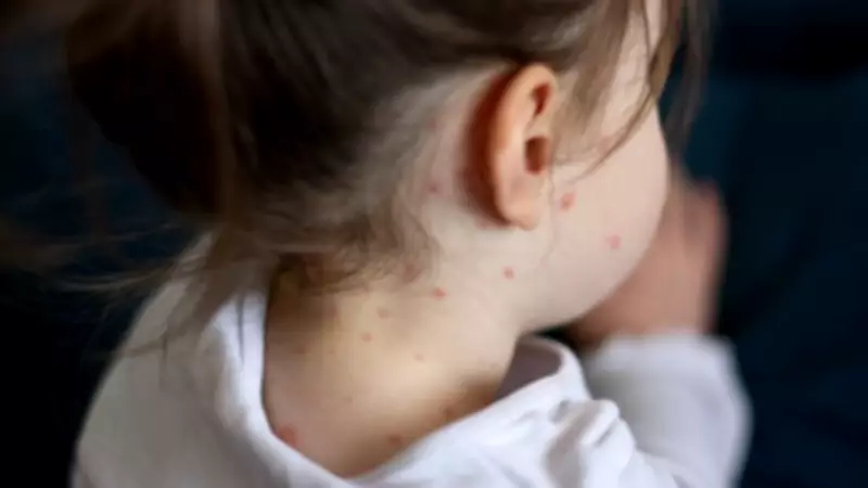 Measles Outbreak in London: Symptoms, Risks, and Urgent Vaccination Call