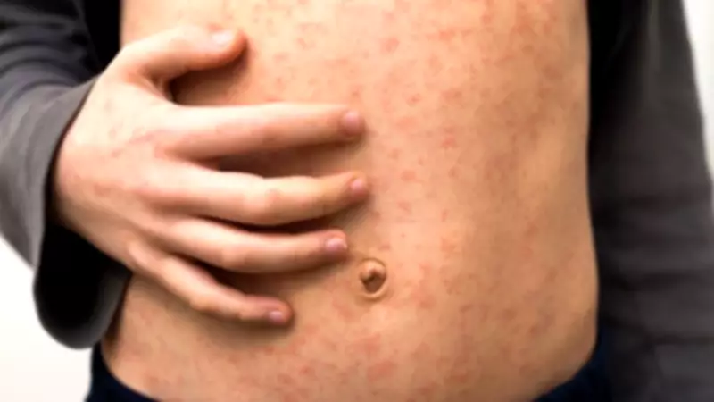 Measles Outbreak Infects Over 60 Children in North London Schools