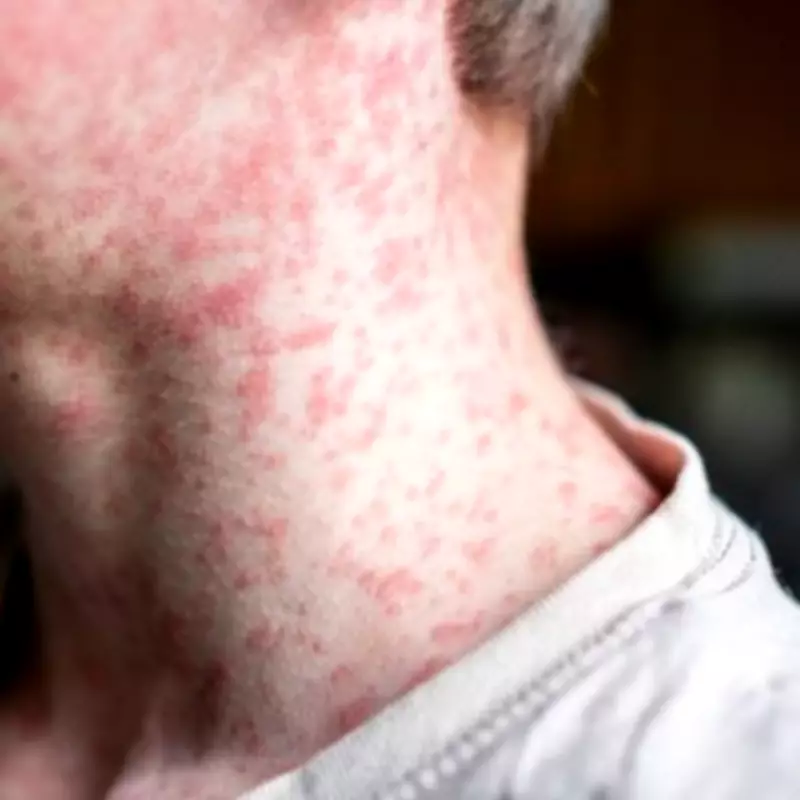 Measles Outbreak Intensifies in London Hotspots with Children Hospitalized