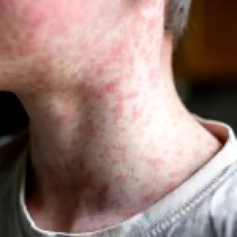 Measles Outbreak Spreads Across UK: London and West Midlands Become Hotspots