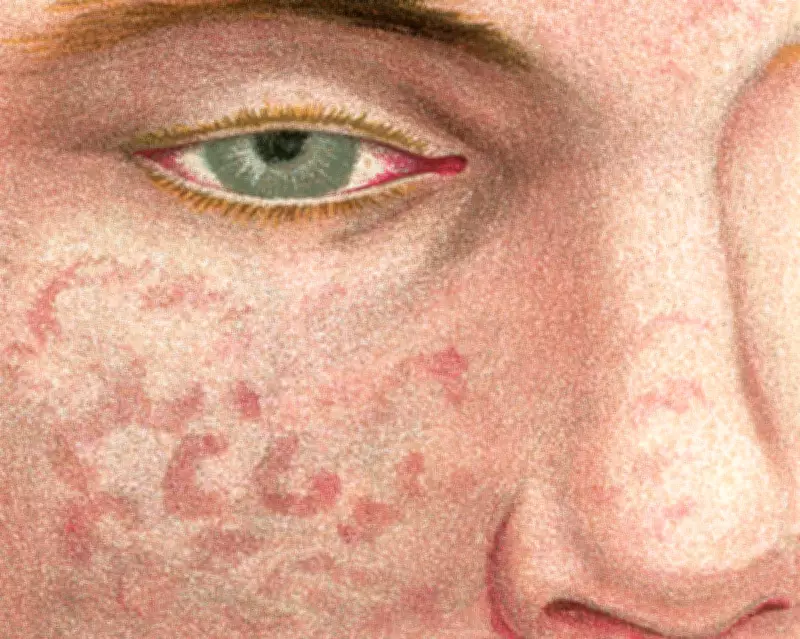 Measles Resurgence in the UK: A Life-Threatening Crisis Driven by Vaccine Hesitancy
