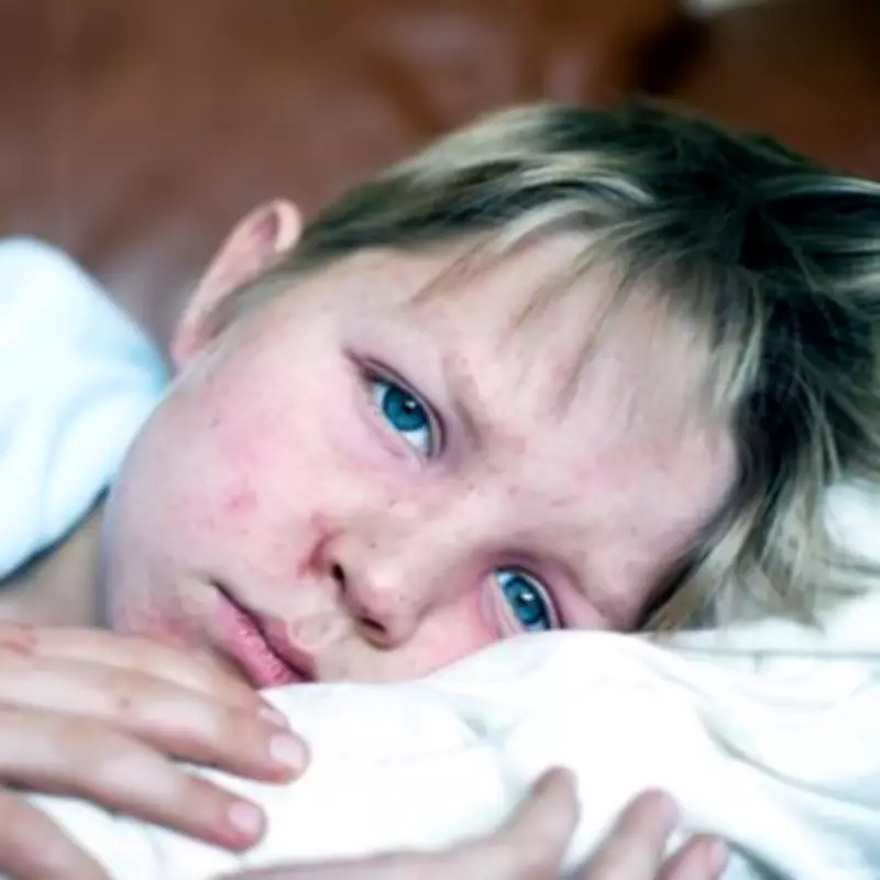 North London Measles Outbreak Hospitalizes 1 in 5 Children, UKHSA Confirms
