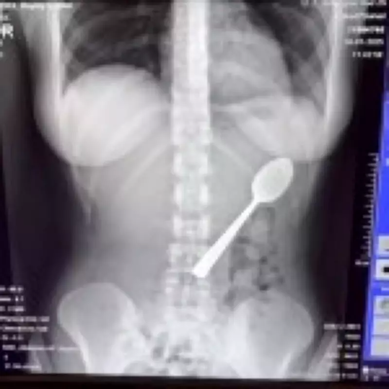 Woman Accidentally Swallows 17cm Spoon After Dog Startles Her
