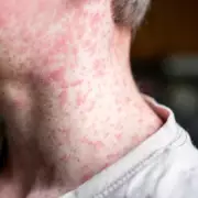 Measles Outbreak Intensifies in London Hotspots with Children Hospitalized