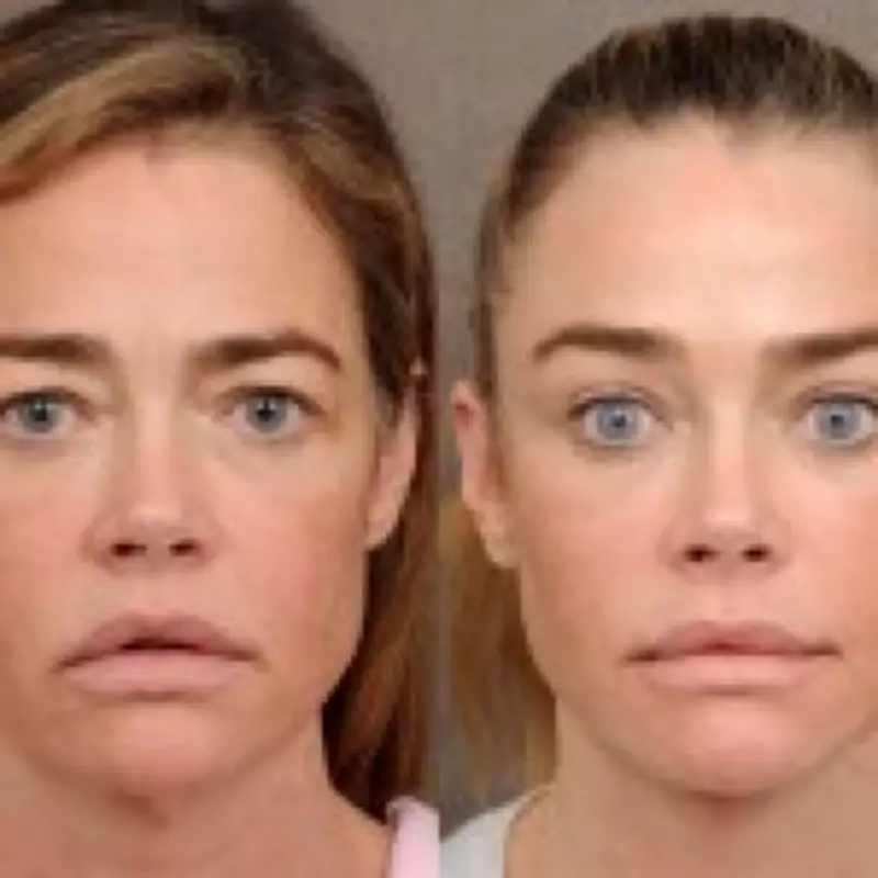 Denise Richards' Facelift Revelation: Transparency or Luxury Marketing?