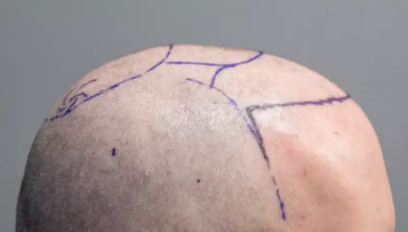 Istanbul Emerges as Global Hair Transplant Hub, Attracting Over a Million Annually