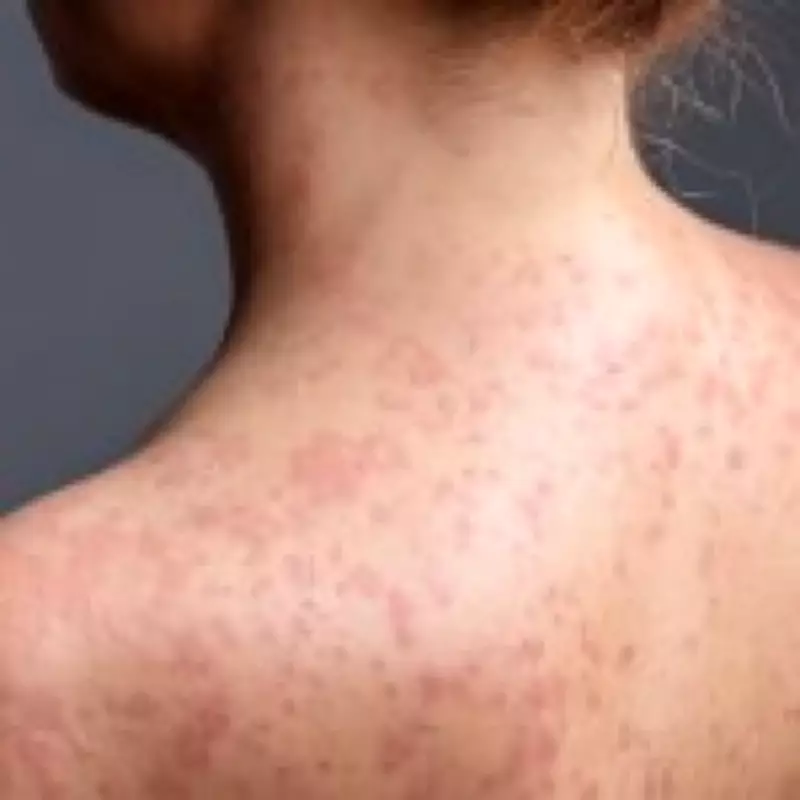 Measles Outbreak in London: 80 Children Infected in Enfield Borough