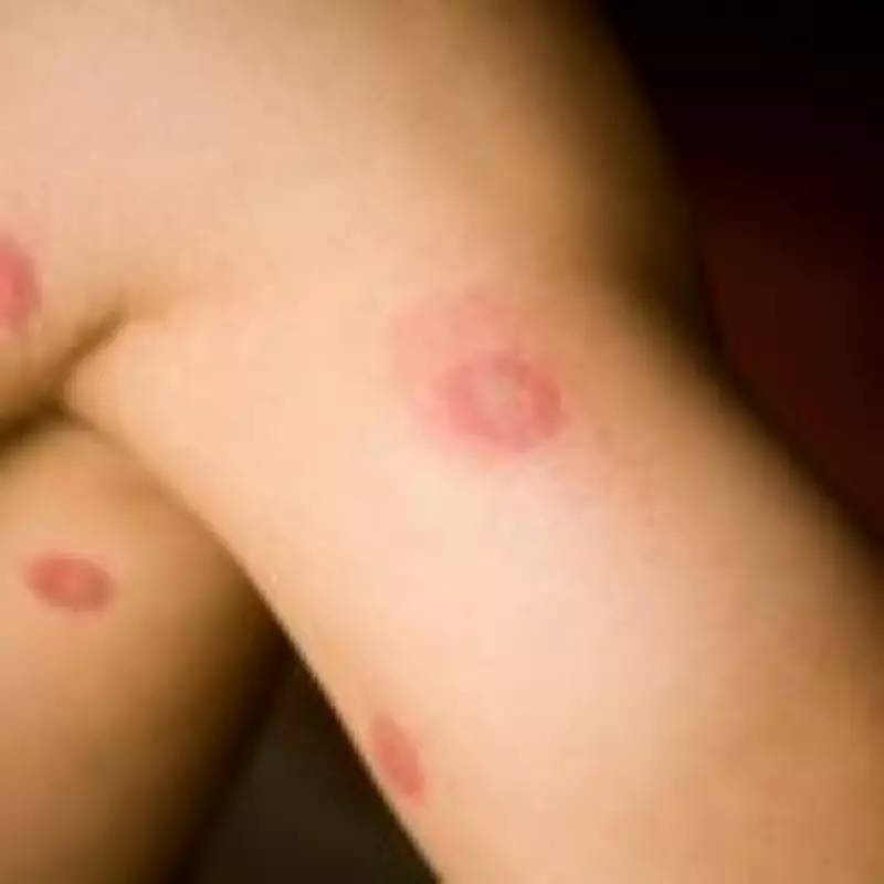 Ringworm Surges in UK Gyms and Barbershops as Many Fail to Recognize Infection