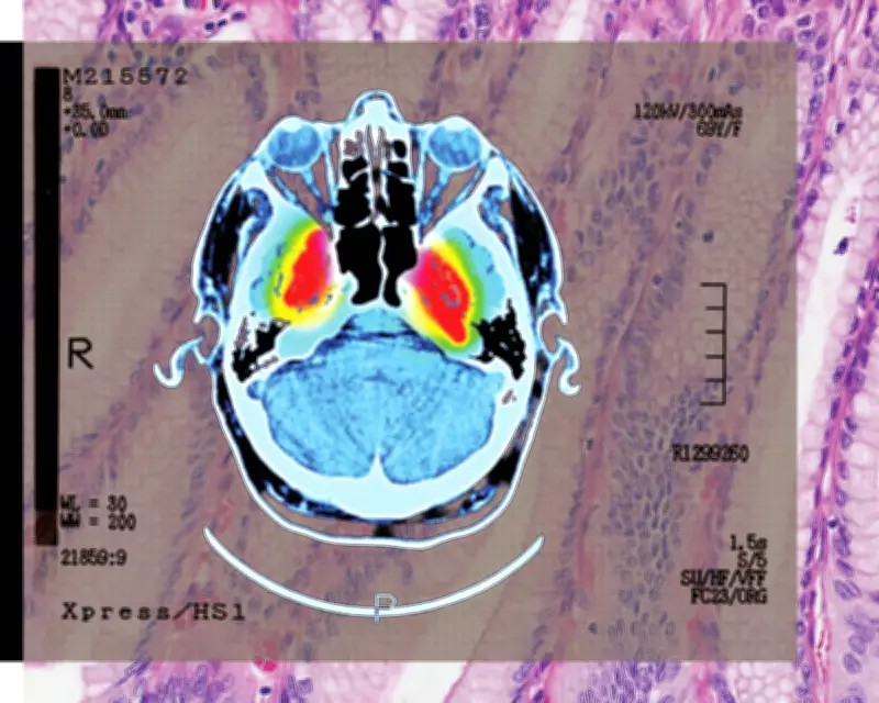 Shingles Vaccine Shows Promise in Reducing Dementia Risk, Study Finds