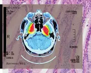 Shingles Vaccine Shows Promise in Reducing Dementia Risk, Study Finds