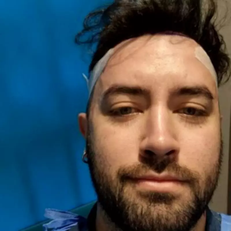 London Actor Cancels Dream Holiday to Spend £5k on Hair Transplant