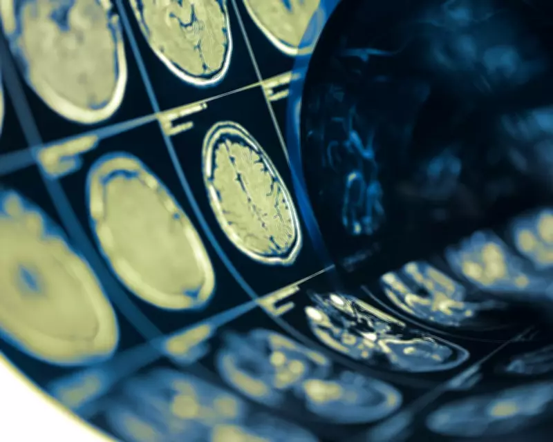 Lacunar Stroke Cause Found: Artery Widening, Not Blockage