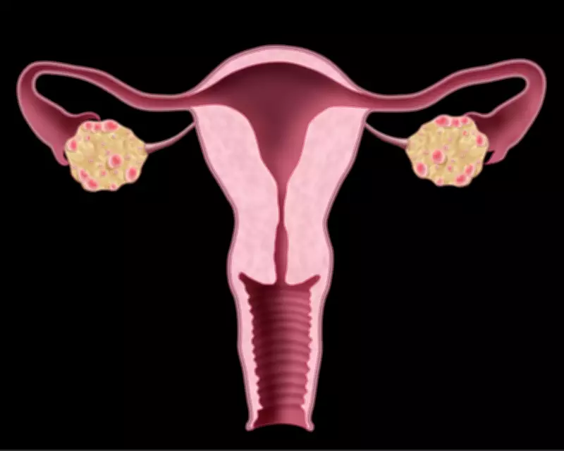NHS Urged to Update Website After PCOS Renamed to PMOS