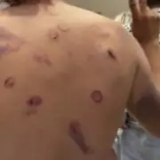 Gaza Flotilla Activists Show Wounds from Israeli Detention
