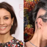 Melanie Sykes reveals extreme alopecia after going 'two-thirds bald'